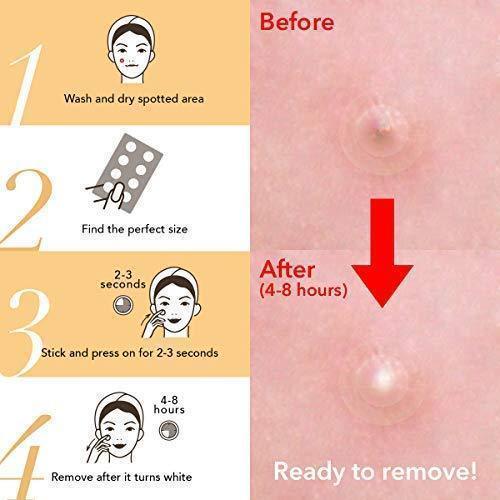 Skin Tag and Acne Patch 24pcs