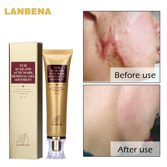 Acne Scar Removal Cream Skin Care Ginseng Extract