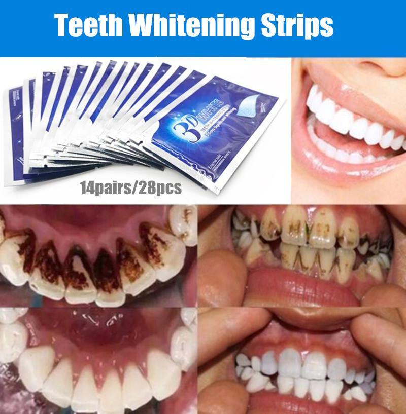 Teeth Whitening Strips